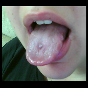 Tongue Retainer Customer Photo